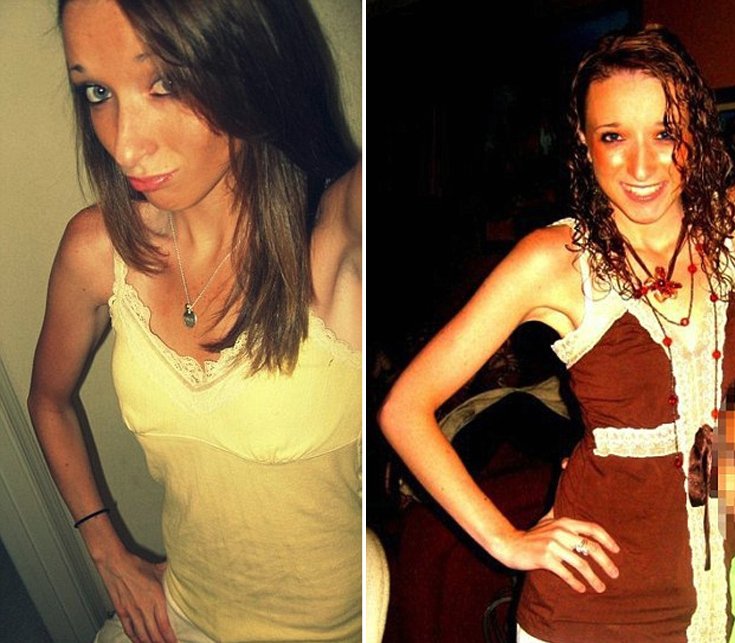 Η συγκλονιστική ιστορία μιας Βρετανίδας– Αρχισε δίαιτα στα 10, ζύγιζε 29 κιλά και έπαθε έμφραγμα στα 17 [εικόνες]  | iefimerida.gr 3