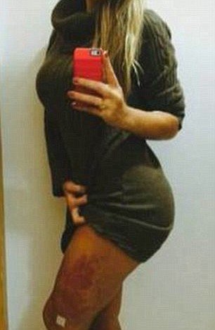 Η Miss BumBum μετανιώνει για την πλαστική στα οπίσθιά της -Το σηπτικό σοκ που τη γέμισε πληγές [εικόνες] | iefimerida.gr 4