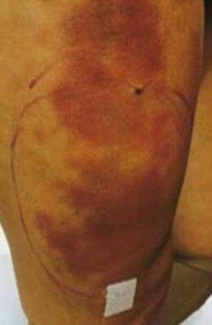 Η Miss BumBum μετανιώνει για την πλαστική στα οπίσθιά της -Το σηπτικό σοκ που τη γέμισε πληγές [εικόνες] | iefimerida.gr 5