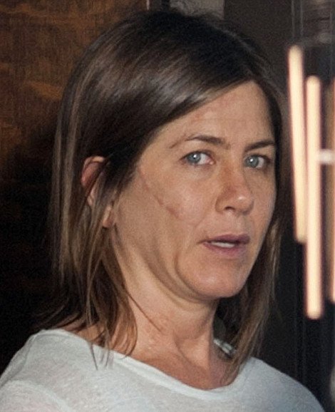 Τι συνέβη στην Τζένιφερ Ανιστον; -Εμφανίστηκε με βαθιές χαρακιές και ράμματα σε πρόσωπο και λαιμό [εικόνες] | iefimerida.gr 2