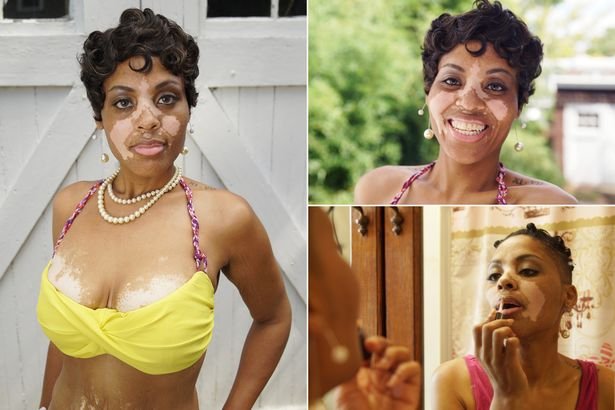 Εχει δερματικό πρόβλημα και λέει πόσο σκληρές είναι μαζί της οι γυναίκες [εικόνες] | iefimerida.gr 0