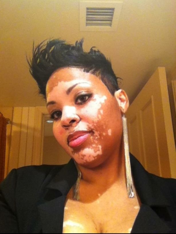 Εχει δερματικό πρόβλημα και λέει πόσο σκληρές είναι μαζί της οι γυναίκες [εικόνες] | iefimerida.gr 1