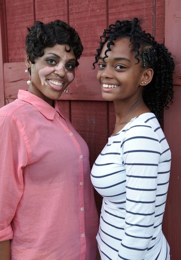 Εχει δερματικό πρόβλημα και λέει πόσο σκληρές είναι μαζί της οι γυναίκες [εικόνες] | iefimerida.gr 3