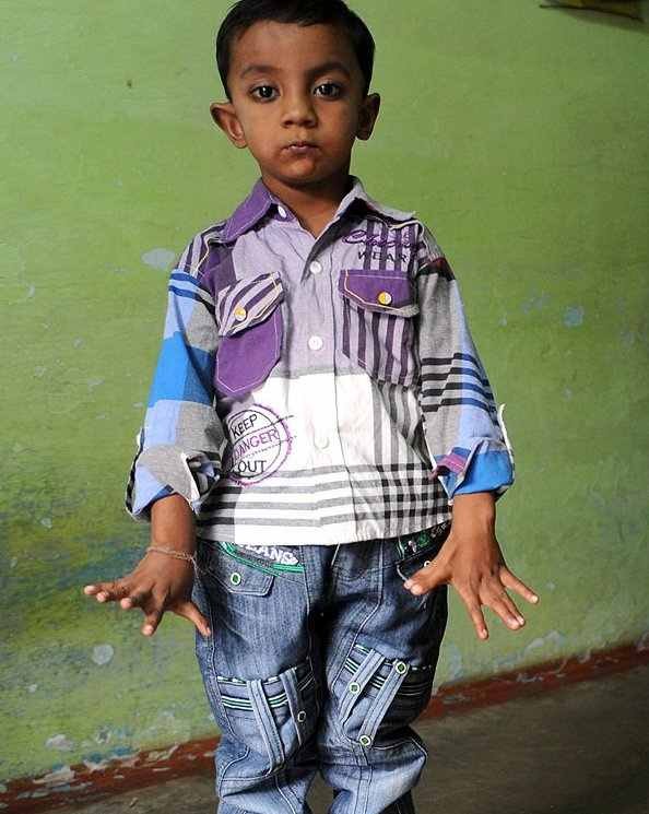 Αυτό είναι το παιδί με τα… 25 δάχτυλα [εικόνες] | iefimerida.gr 0