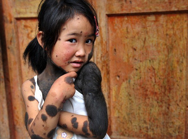 Την εγκατάλειψαν οι γονείς της επειδή γεννήθηκε με πυκνό τρίχωμα [εικόνες]  | iefimerida.gr 0