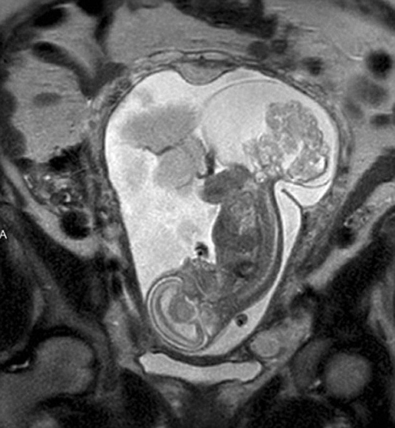 Ιατρικό θαύμα: Το μωρό που γεννήθηκε δύο φορές [εικόνες] | iefimerida.gr 1