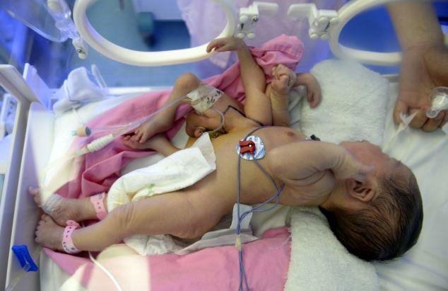 Μωρό γεννήθηκε με τέσσερα χέρια και πόδια -Οι γιατροί κατάφεραν να τα αφαιρέσουν [εικόνες] | iefimerida.gr 0