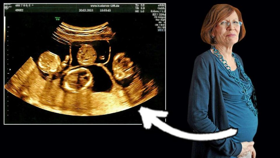 H 65χρονη Γερμανίδα-φαινόμενο γέννησε τετράδυμα, πρόωρα [εικόνες] | iefimerida.gr 2