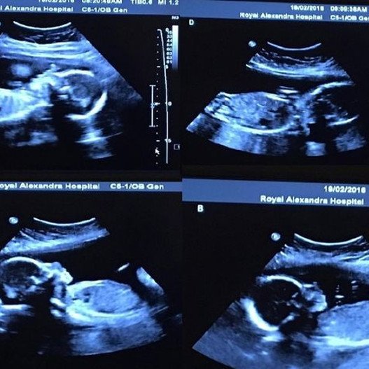 Ηθελαν ένα παιδάκι για να ολοκληρώσουν την ευτυχία τους -Έρχονται τέσσερα! [εικόνες & βίντεο] | iefimerida.gr 2