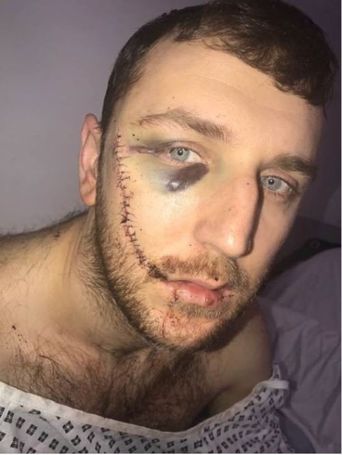 Σοκαριστικά επεισόδια: Μαχαιρωμένος στο πρόσωπο οπαδός της Εβερτον [εικόνες & βίντεο] | iefimerida.gr 1