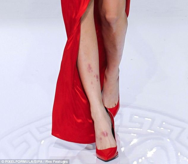 Η Cara Delevigne μιλάει ανοιχτά για τη μάχη που δίνει με την ψωρίαση [εικόνες] | iefimerida.gr 0