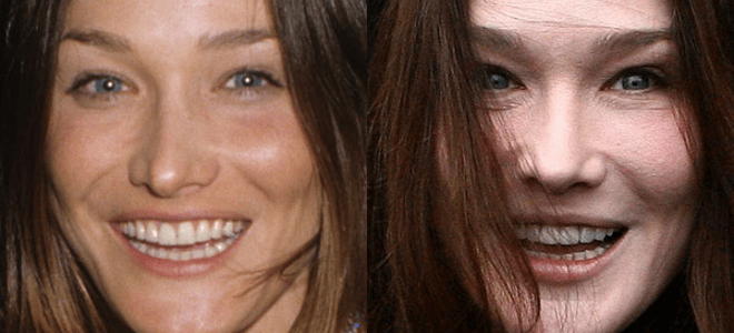 H Carla Bruni θύμα υπερβολικού μπότοξ [εικόνες] | iefimerida.gr 2