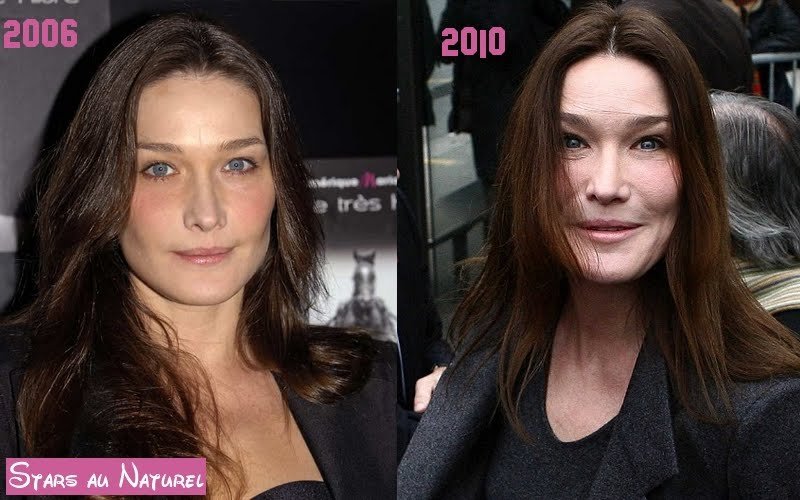 H Carla Bruni θύμα υπερβολικού μπότοξ [εικόνες] | iefimerida.gr 0