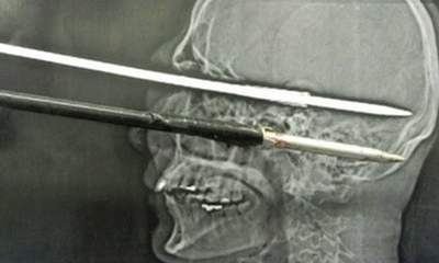 Καμάκι διαπέρασε το κρανίο του και τη... γλίτωσε! [εικόνες] | iefimerida.gr 0