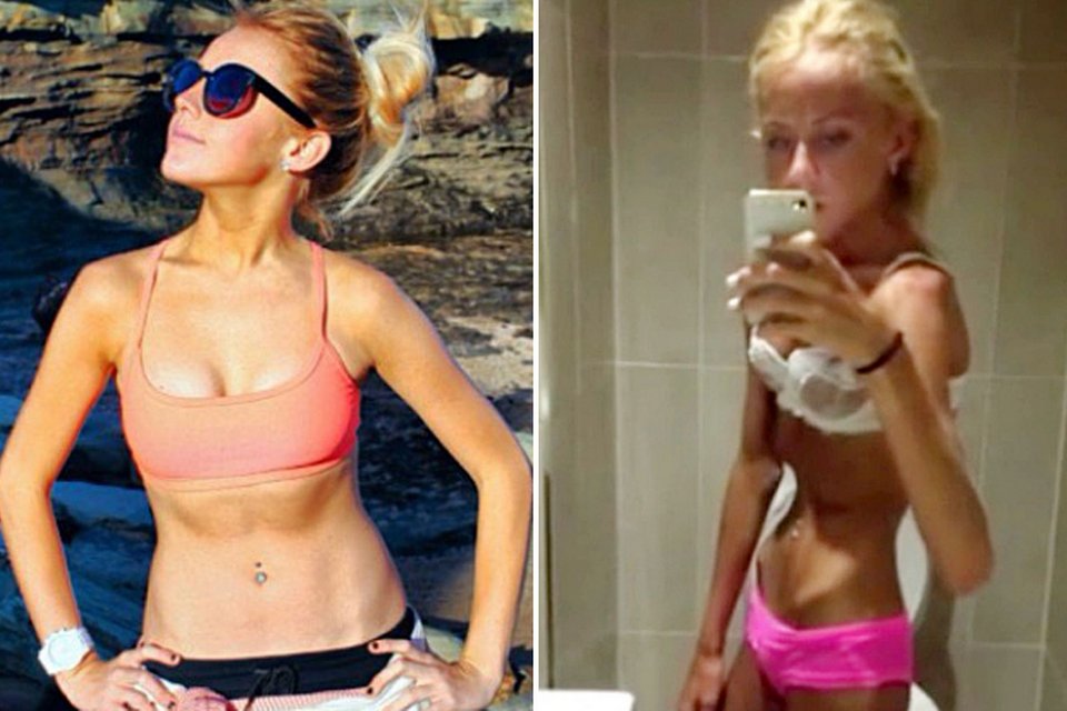 18χρονη έφτασε τα 30 κιλά [εικόνες] | iefimerida.gr 0