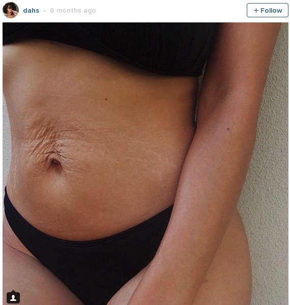 Νέα μαμά «την λέει» στις τέλειες γυναίκες: Ετσι είναι το σώμα μετά τη γέννα -Με σημάδια [εικόνες] | iefimerida.gr 1