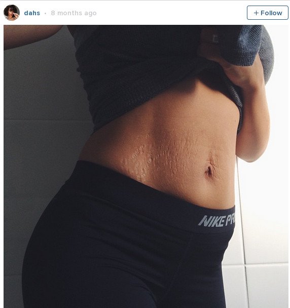 Νέα μαμά «την λέει» στις τέλειες γυναίκες: Ετσι είναι το σώμα μετά τη γέννα -Με σημάδια [εικόνες] | iefimerida.gr 2