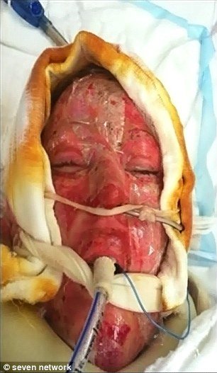 H γυναίκα με τη μάσκα αποκάλυψε το πρόσωπό της -Τη φορούσε 2,5 χρόνια, είχε φριχτά εγκαύματα μετά από επίθεση [εικόνες] | iefimerida.gr 0