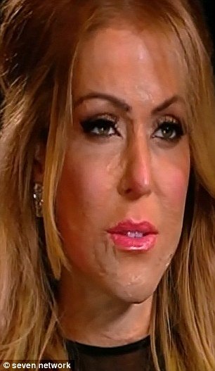 H γυναίκα με τη μάσκα αποκάλυψε το πρόσωπό της -Τη φορούσε 2,5 χρόνια, είχε φριχτά εγκαύματα μετά από επίθεση [εικόνες] | iefimerida.gr 1