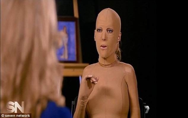 H γυναίκα με τη μάσκα αποκάλυψε το πρόσωπό της -Τη φορούσε 2,5 χρόνια, είχε φριχτά εγκαύματα μετά από επίθεση [εικόνες] | iefimerida.gr 6