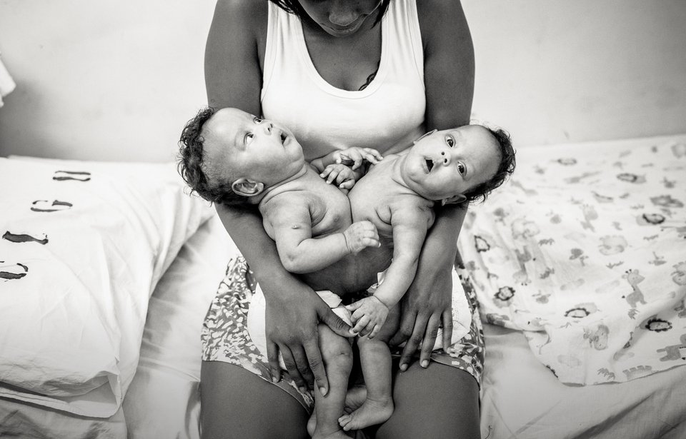 Κλάρα και Εντουάρντα: Τα δίδυμα σιαμαία που χωρίστηκαν με επιτυχία [εικόνες] | iefimerida.gr 0