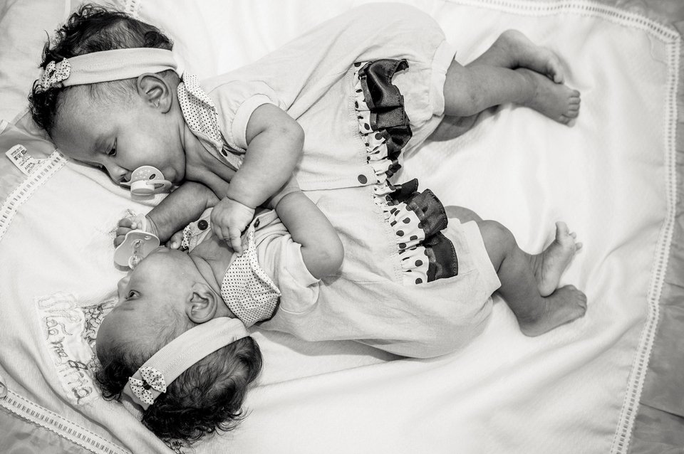 Κλάρα και Εντουάρντα: Τα δίδυμα σιαμαία που χωρίστηκαν με επιτυχία [εικόνες] | iefimerida.gr 2