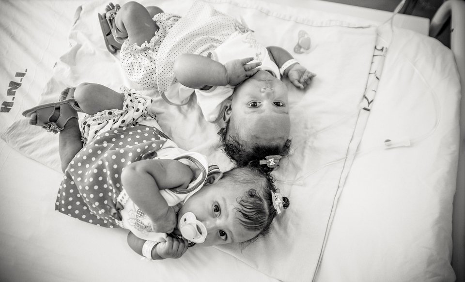 Κλάρα και Εντουάρντα: Τα δίδυμα σιαμαία που χωρίστηκαν με επιτυχία [εικόνες] | iefimerida.gr 3