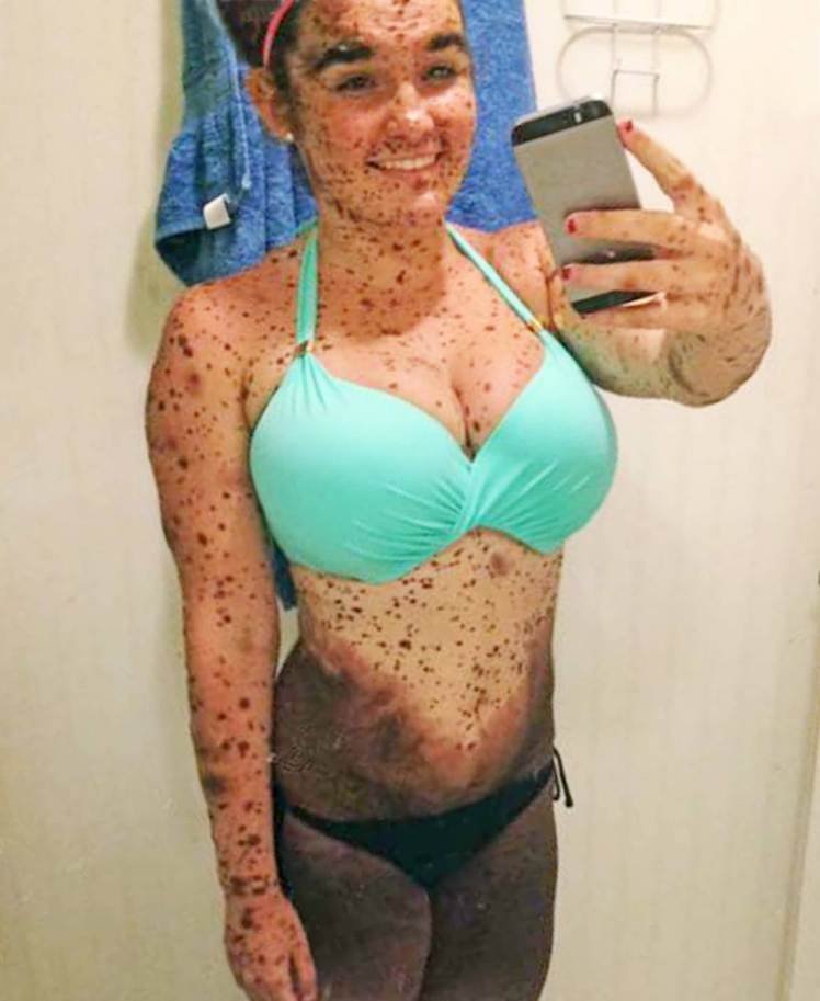 Η 19χρονη που το σώμα της είναι καλυμμένο κατά 70% με ελιές [εικόνες] | iefimerida.gr 3