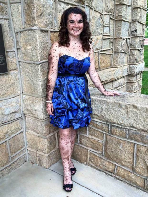 Η 19χρονη που το σώμα της είναι καλυμμένο κατά 70% με ελιές [εικόνες] | iefimerida.gr 2