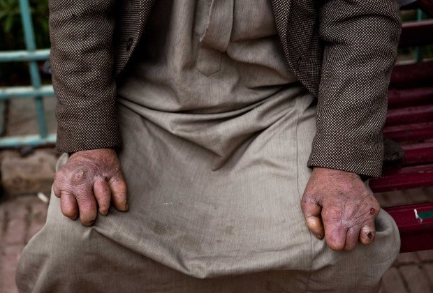 Αμπού Τζααμπάλ: H μεγαλύτερη αποικία λεπρών της Μ. Ανατολής που οι τρόφιμοι αρνούνται να την  εγκαταλείψουν [εικόνες]  | iefimerida.gr 6