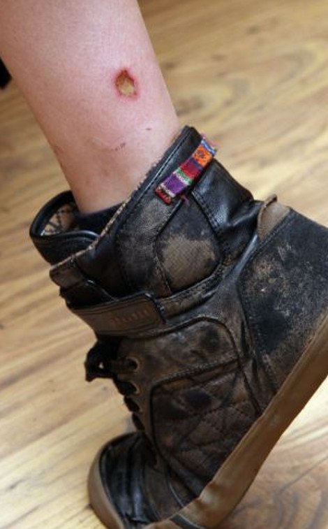 Στο νοσοκομείο 11χρονος με εγκαύματα μετά από έκρηξη BlackBerry κινητού [εικόνες] | iefimerida.gr 2