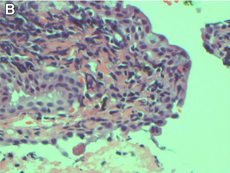 Τι μπορεί να πάθεις αν δεν αφαιρείς τη μάσκαρα κάθε βράδυ –Η τρομακτική περίπτωση μιας 50χρονης [εικόνες] | iefimerida.gr 2