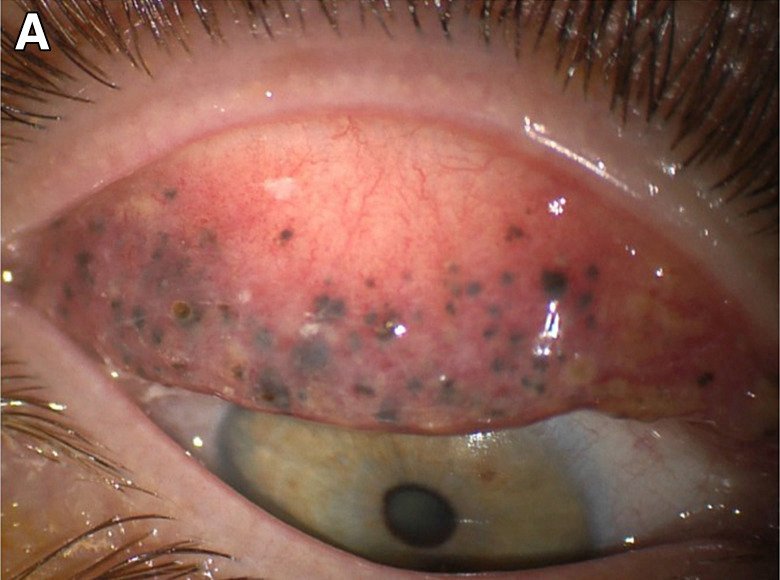 Τι μπορεί να πάθεις αν δεν αφαιρείς τη μάσκαρα κάθε βράδυ –Η τρομακτική περίπτωση μιας 50χρονης [εικόνες] | iefimerida.gr 1