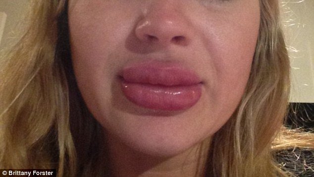 Φούσκωσε τα χείλη της με συσκευή βεντούζα για να μοιάσει στην Καρντάσιαν [εικόνες] | iefimerida.gr 1