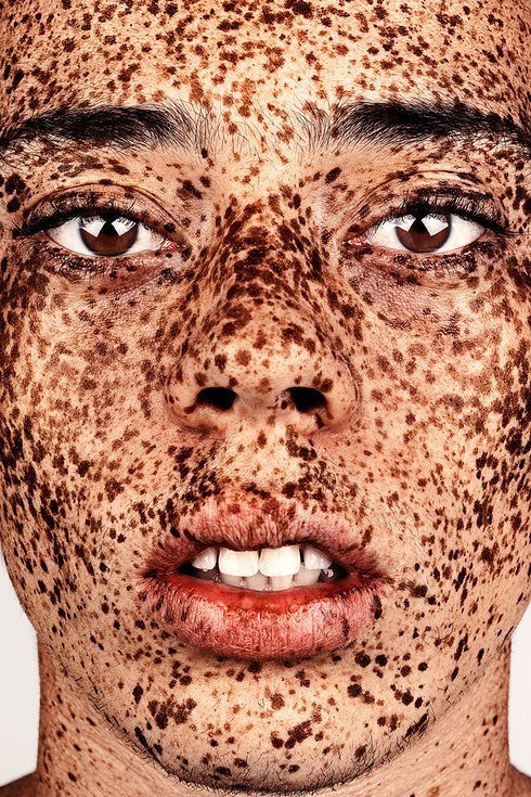 Η ομορφιά των φακίδων -Εντυπωσιακά πορτραίτα ανδρών και γυναικών [εικόνες] | iefimerida.gr 2