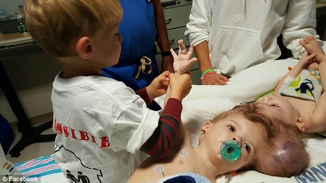 Σιαμαία που ήταν ενωμένα στο κεφάλι βλέπουν για πρώτη φορά το ένα το άλλο [εικόνες] | iefimerida.gr 3