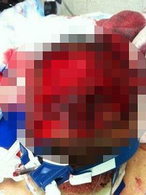 Αυτός είναι ο άστεγος που του έφαγε 75% του προσώπου ο Zombie Killer [εικόνες] | iefimerida.gr 1