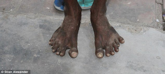 Ινδός με 12 δάχτυλα δε βρίσκει δουλειά ως ...δακτυλογράφος-Γιατί τον απορρίπτουν στη χώρα του [εικόνες] | iefimerida.gr 1