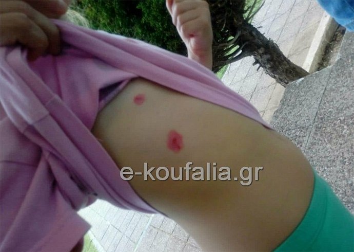 Εικόνες: 7χρονη δέχτηκε επίθεση από τρία αδέσποτα σκυλιά στη Θεσσαλονίκη | iefimerida.gr 2