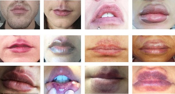 Φούσκωσε τα χείλη της με συσκευή βεντούζα για να μοιάσει στην Καρντάσιαν [εικόνες] | iefimerida.gr 4