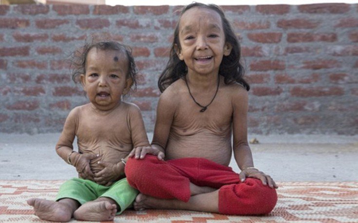 Οι σύγχρονοι «Μπέντζαμιν Μπάτον» -Δυο αδελφάκια από την Ινδία μοιάζουν με ηλικιωμένους 80 χρονών [εικόνες]  | iefimerida.gr 0