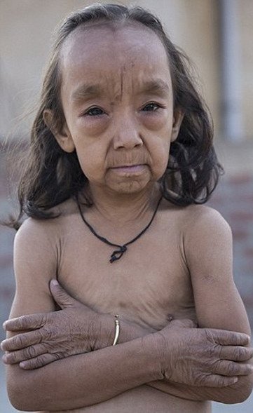 Οι σύγχρονοι «Μπέντζαμιν Μπάτον» -Δυο αδελφάκια από την Ινδία μοιάζουν με ηλικιωμένους 80 χρονών [εικόνες]  | iefimerida.gr 1