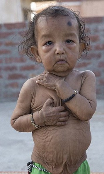 Οι σύγχρονοι «Μπέντζαμιν Μπάτον» -Δυο αδελφάκια από την Ινδία μοιάζουν με ηλικιωμένους 80 χρονών [εικόνες]  | iefimerida.gr 2