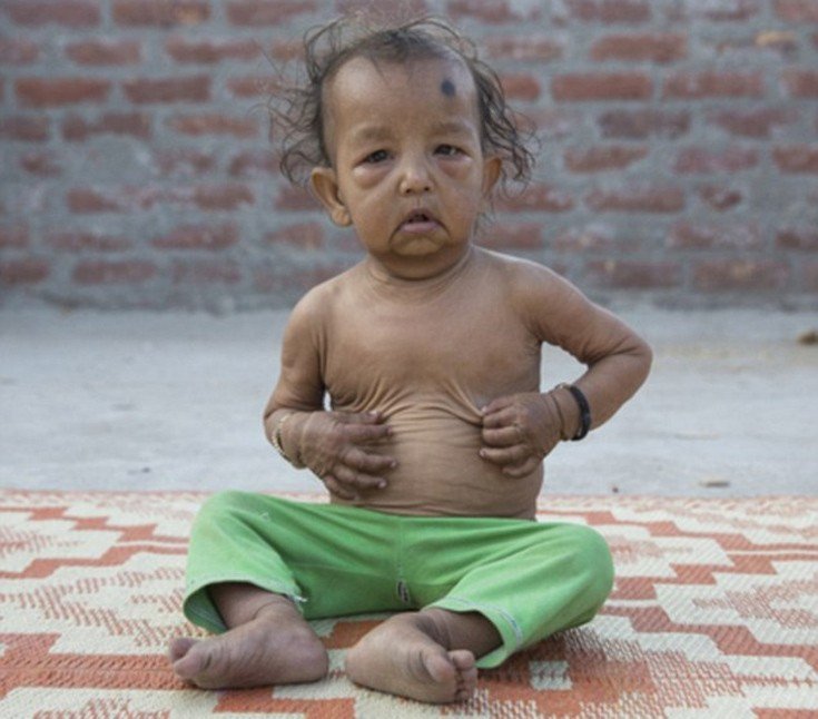 Οι σύγχρονοι «Μπέντζαμιν Μπάτον» -Δυο αδελφάκια από την Ινδία μοιάζουν με ηλικιωμένους 80 χρονών [εικόνες]  | iefimerida.gr 3