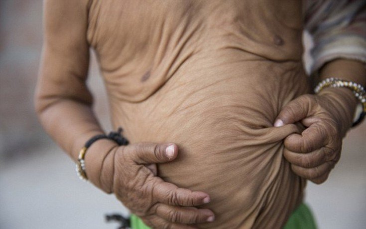 Οι σύγχρονοι «Μπέντζαμιν Μπάτον» -Δυο αδελφάκια από την Ινδία μοιάζουν με ηλικιωμένους 80 χρονών [εικόνες]  | iefimerida.gr 4