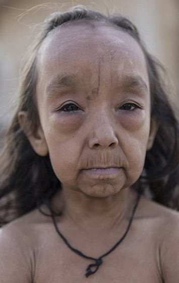 Οι σύγχρονοι «Μπέντζαμιν Μπάτον» -Δυο αδελφάκια από την Ινδία μοιάζουν με ηλικιωμένους 80 χρονών [εικόνες]  | iefimerida.gr 5