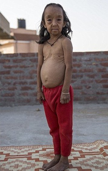 Οι σύγχρονοι «Μπέντζαμιν Μπάτον» -Δυο αδελφάκια από την Ινδία μοιάζουν με ηλικιωμένους 80 χρονών [εικόνες]  | iefimerida.gr 6