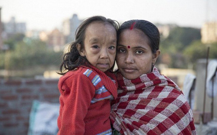 Οι σύγχρονοι «Μπέντζαμιν Μπάτον» -Δυο αδελφάκια από την Ινδία μοιάζουν με ηλικιωμένους 80 χρονών [εικόνες]  | iefimerida.gr 7