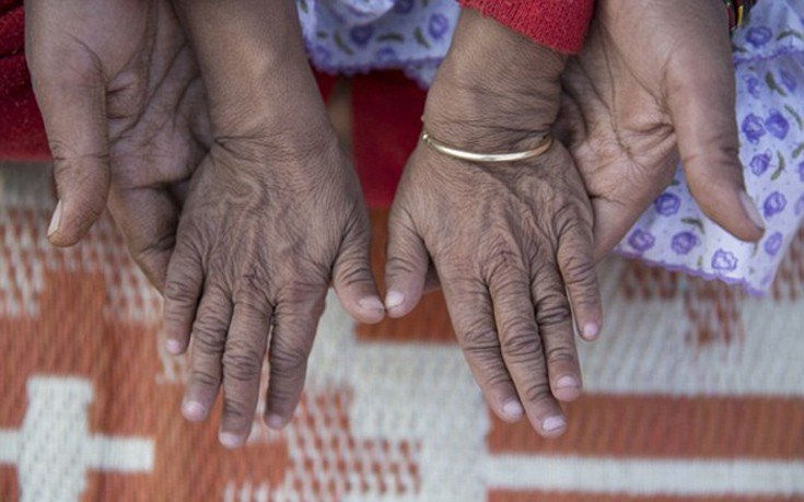 Οι σύγχρονοι «Μπέντζαμιν Μπάτον» -Δυο αδελφάκια από την Ινδία μοιάζουν με ηλικιωμένους 80 χρονών [εικόνες]  | iefimerida.gr 8