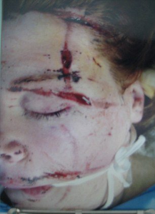 Η βιονική γυναίκα: Στρατιώτης επέζησε από έκρηξη σε πόλεμο και πλήρωσε 62.000 ευρώ για την «ανακατασκευή» της [εικόνες] | iefimerida.gr 2